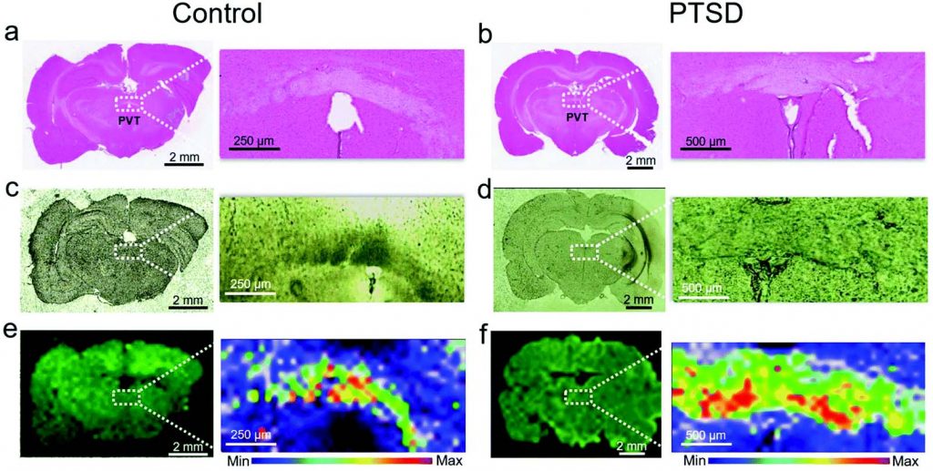 Label-free lipidome study of paraventricular thalamic nucleus (PVT) of rat brain with post-traumatic stress injury by Raman imaging